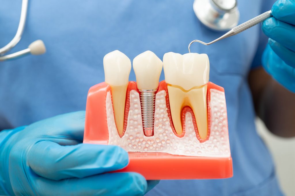 With Dental Implants