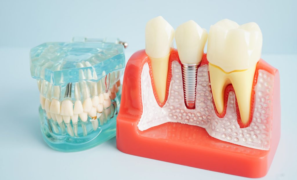 Dental Implants Pros and Cons